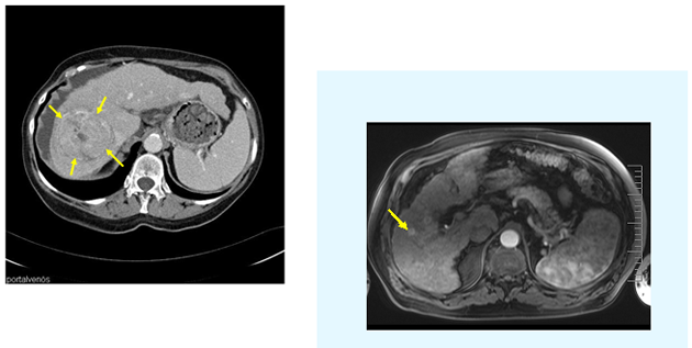 CT- and MRI-images of HCCs
