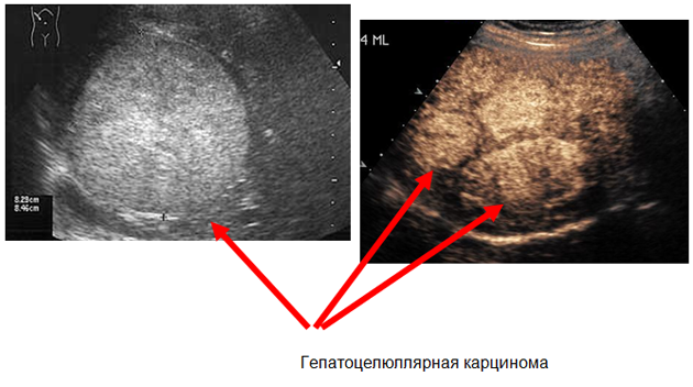 Рисунок 3: Ультразвуковая картина гепатоцелюллярной карциномы