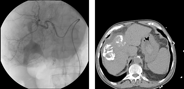 Transarterial (chemo-) embolisation of hepatocellular cancer (HCC)