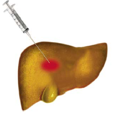 Local destroyal of tumor (local ablation) by ethanol